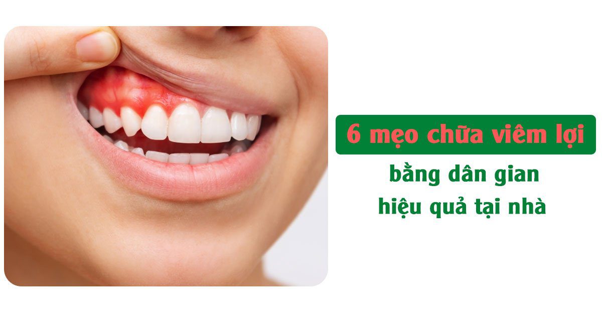 6 mẹo chữa viêm lợi bằng dân gian hiệu quả tại nhà