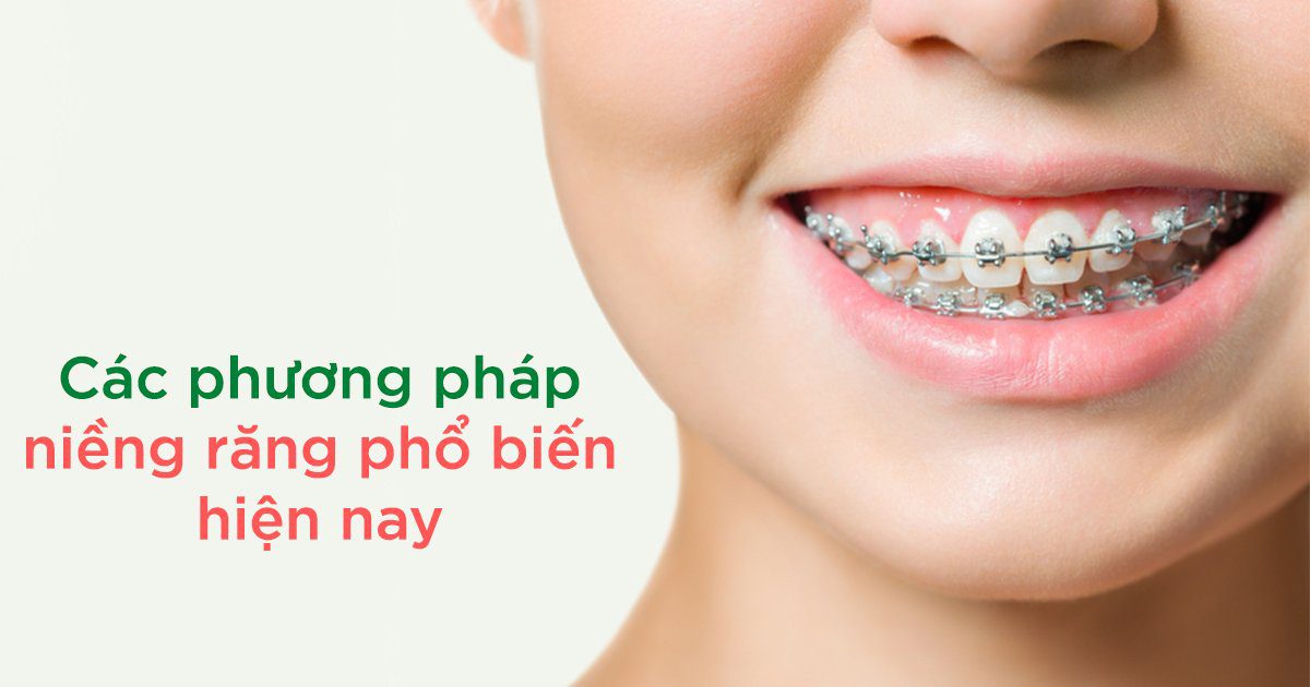 Niềng răng là gì? 3 giải pháp niềng răng phổ biến