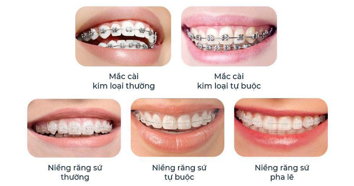 Niềng răng mắc cài