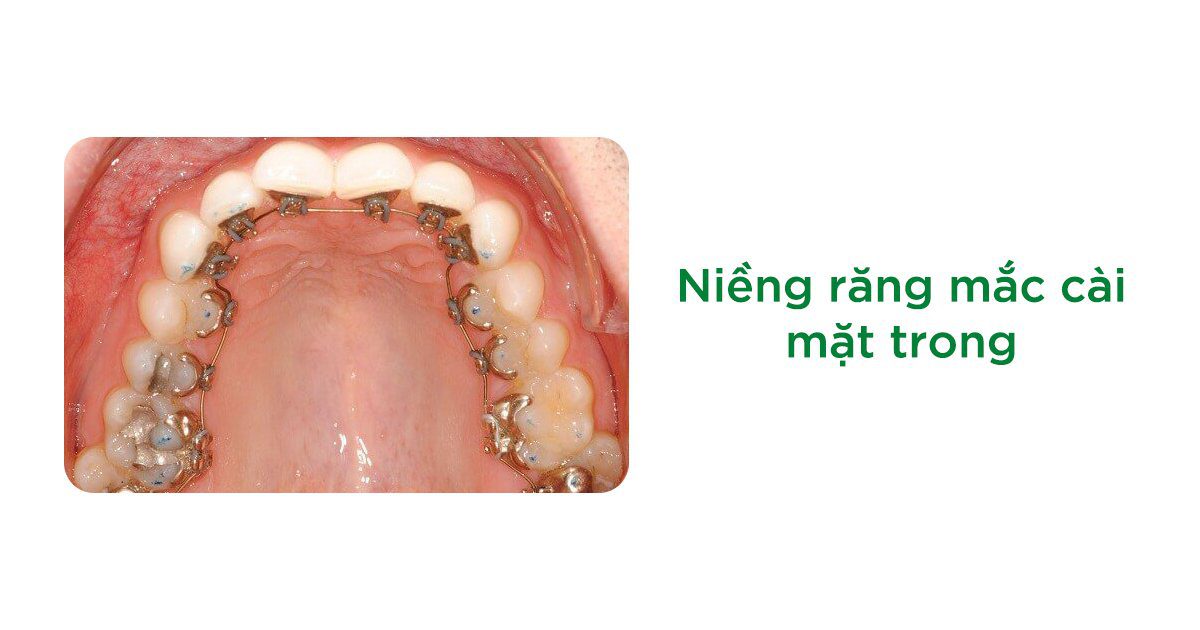 Niềng răng mặt trong