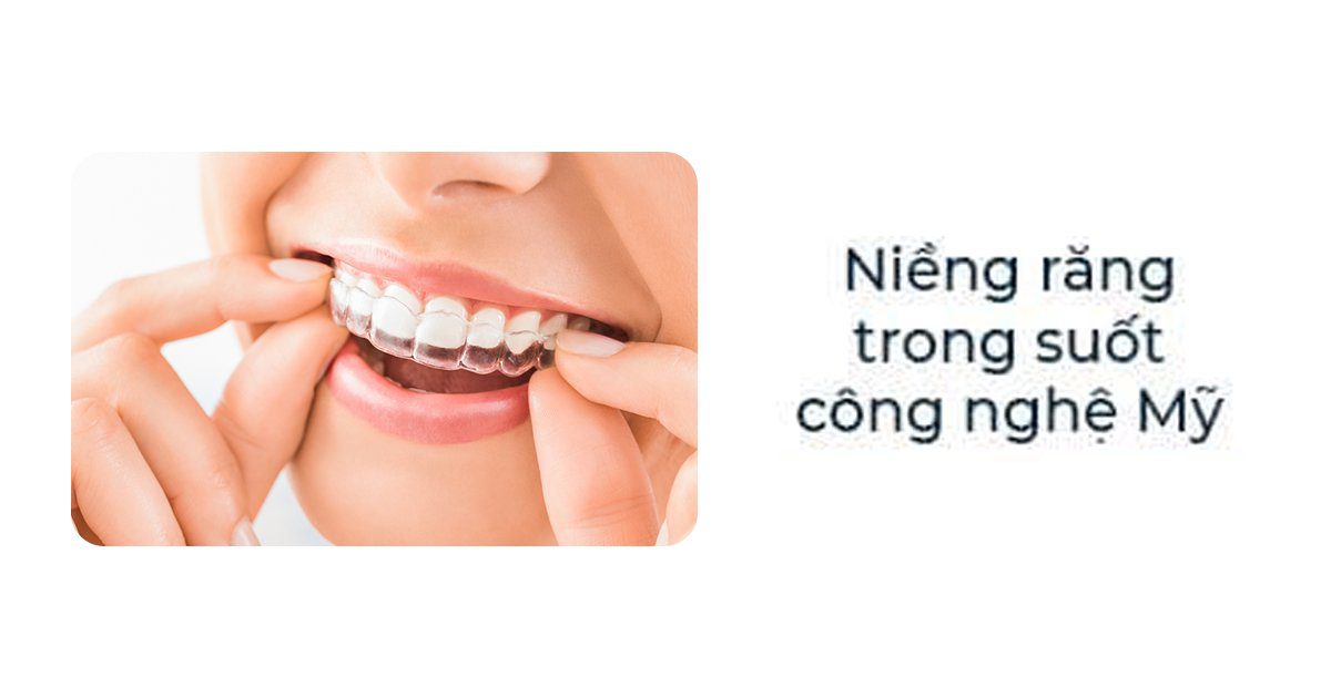 Niềng trong suốt