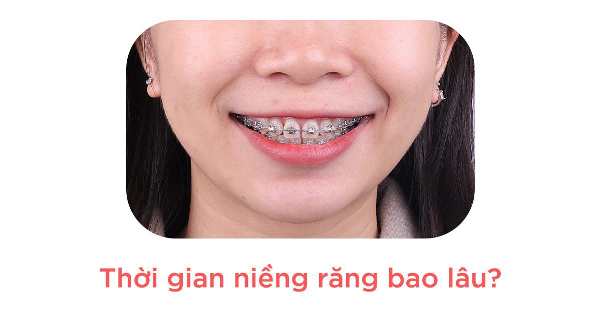 Thời gian niềng răng bao lâu