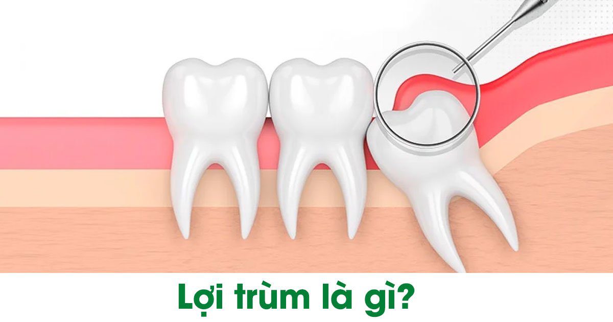 Lợi trùm là gì?