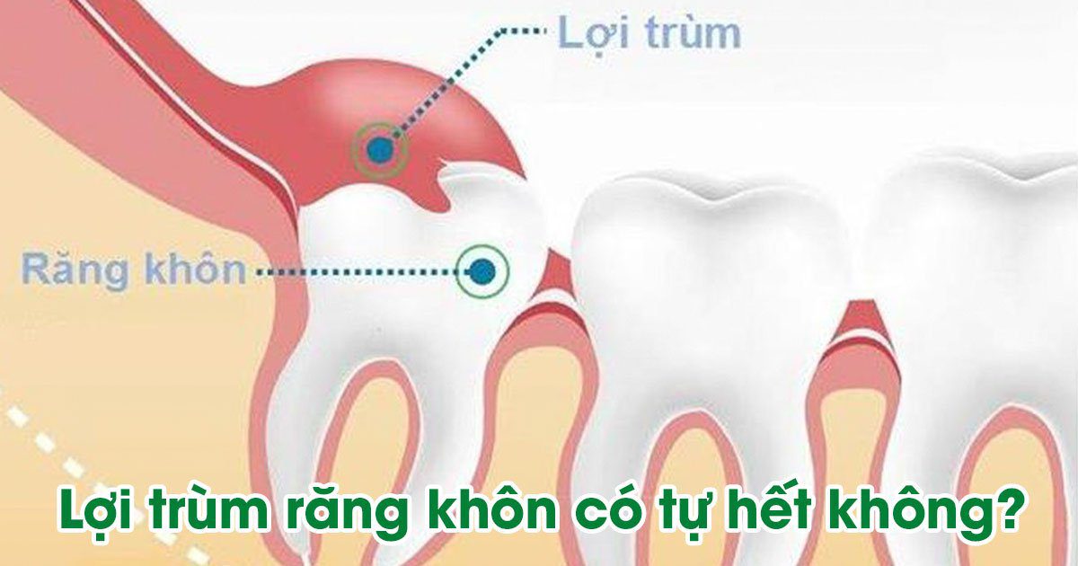 Lợi trùm răng khôn có tự hết không?