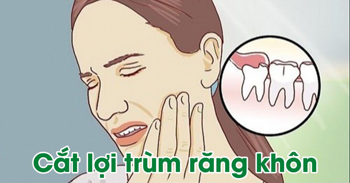 Cắt lợi trùm răng khôn