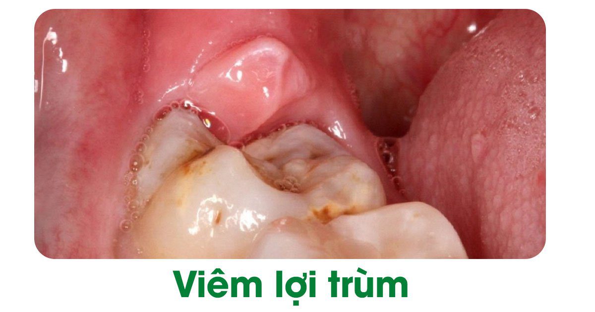 Hình ảnh viêm lợi trùm