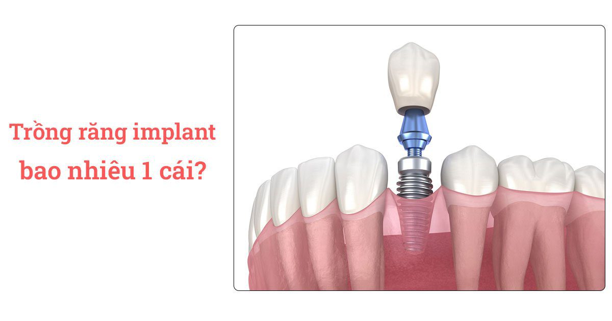 Trồng răng implant bao nhiêu 1 cái? 14 Trồng răng implant bao nhiêu 1 cái?