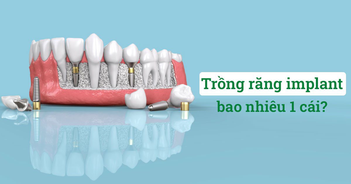 Trồng răng implant bao nhiêu 1 cái? 8 Trồng răng implant bao nhiêu 1 cái?