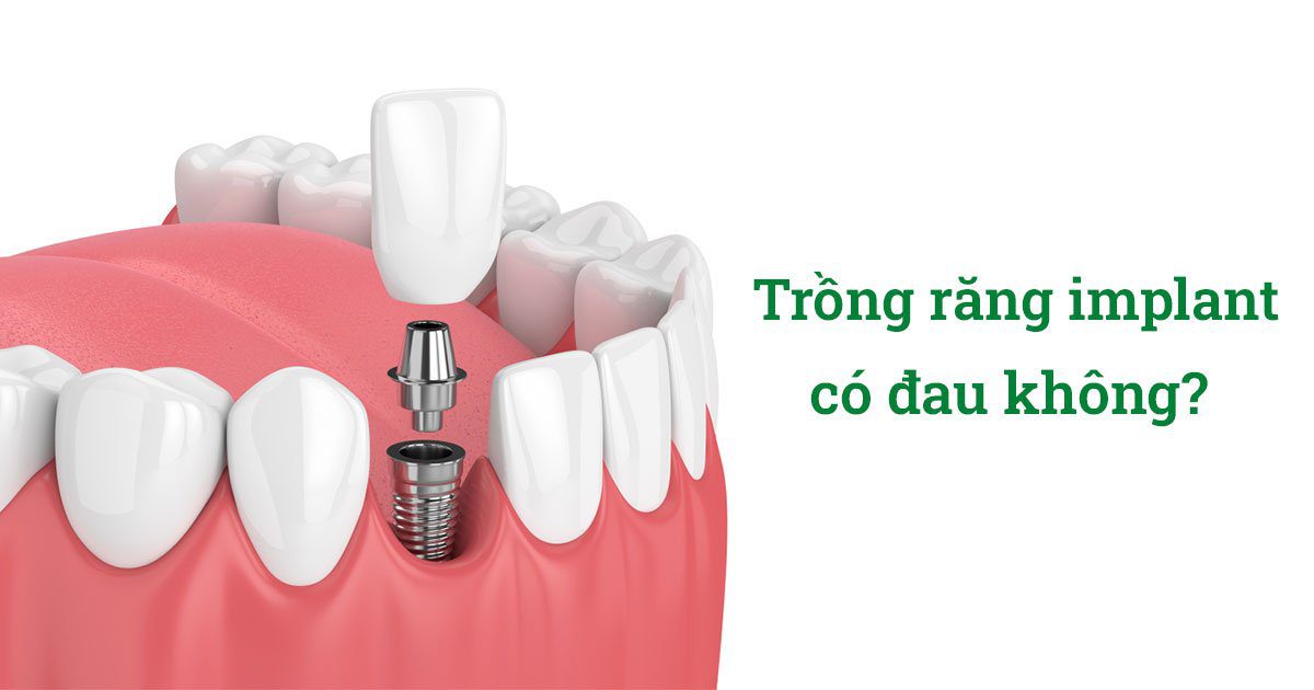 Trồng răng implant bao nhiêu 1 cái? 11 Trồng răng implant có đau không?