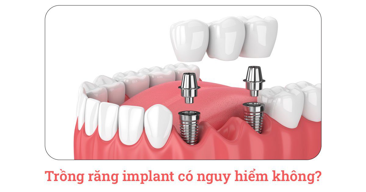Trồng răng implant bao nhiêu 1 cái? 13 Trồng răng implant có nguy hiểm không?