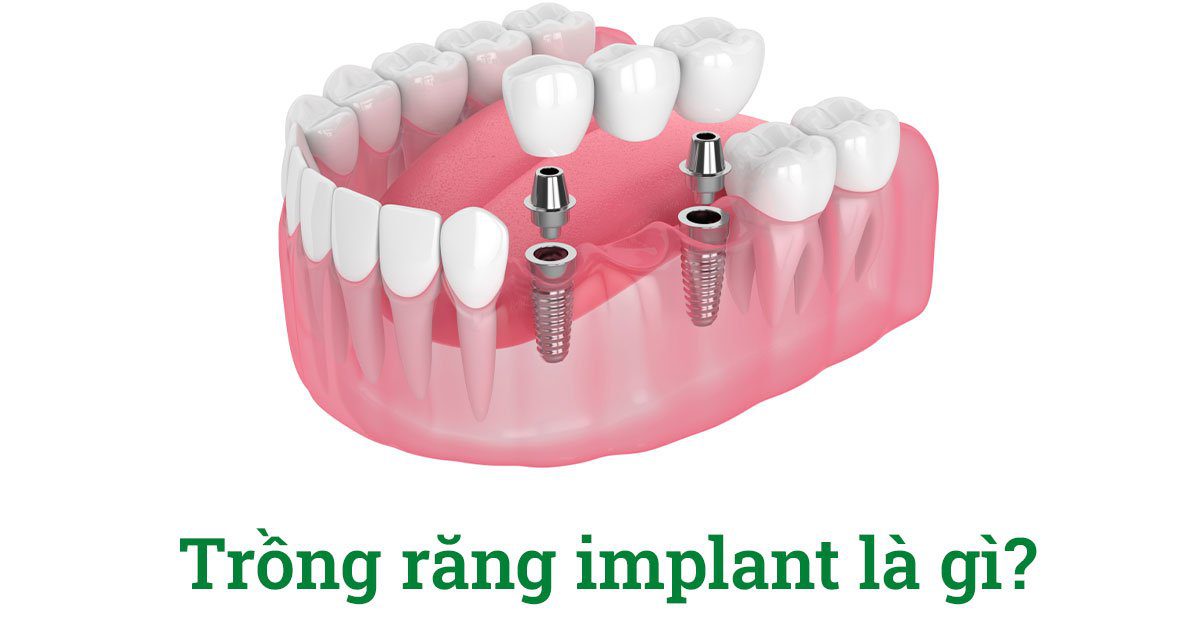 Trồng răng implant bao nhiêu 1 cái? 9 Trồng răng implant là gì?