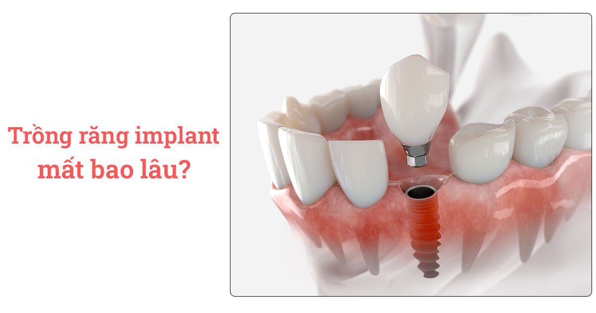 Trồng răng implant bao nhiêu 1 cái? 12 Trồng răng implant mất bao lâu?