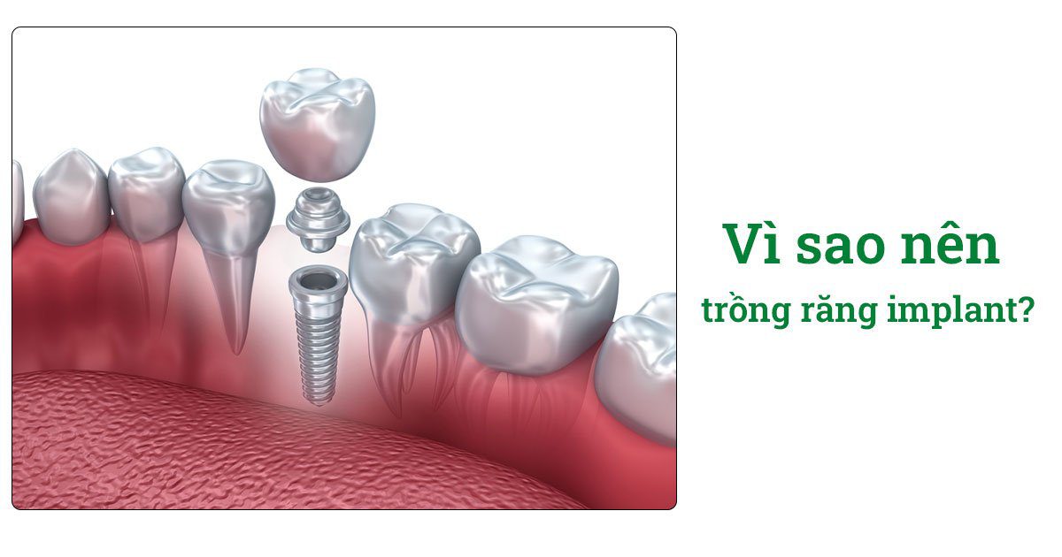 Trồng răng implant bao nhiêu 1 cái? 10 Vì sao nên trồng răng implant?
