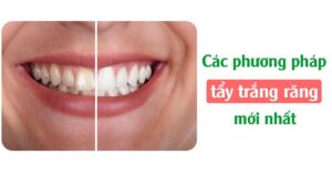 Phương pháp tẩy trắng răng