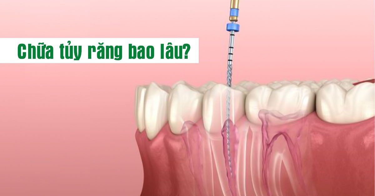 Chữa tủy răng bao lâu?