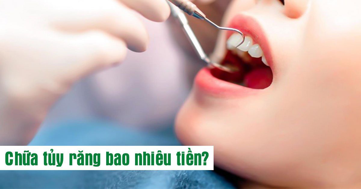 Chữa tủy răng bao nhiêu tiền?