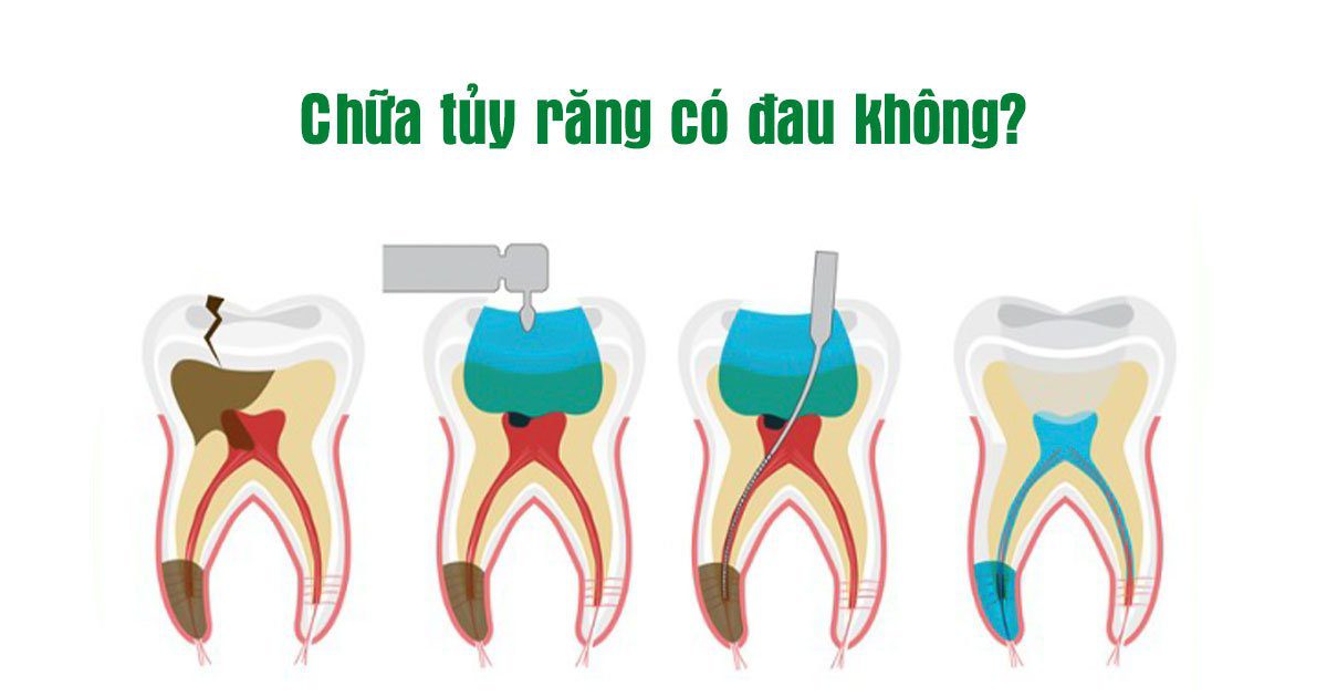 Chữa tủy răng có đau không?