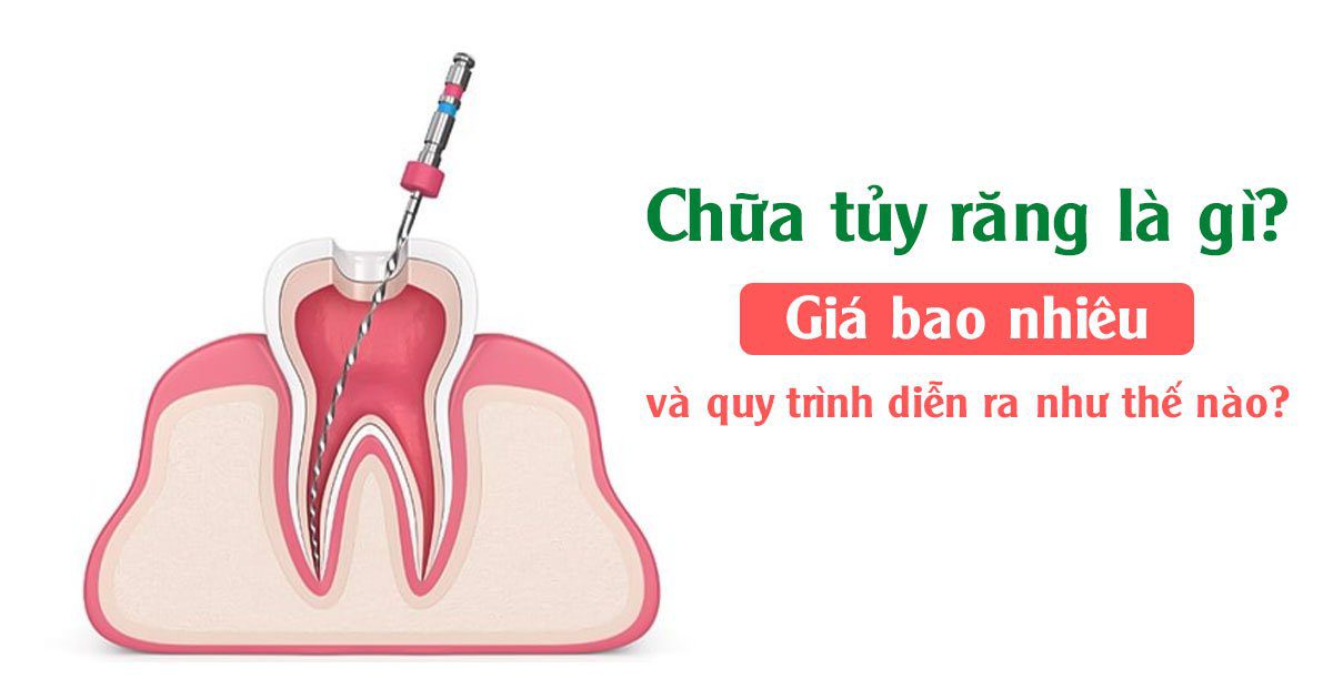 Chữa tủy răng là gì? Giá bao nhiêu và quy trình diễn ra như thế nào?