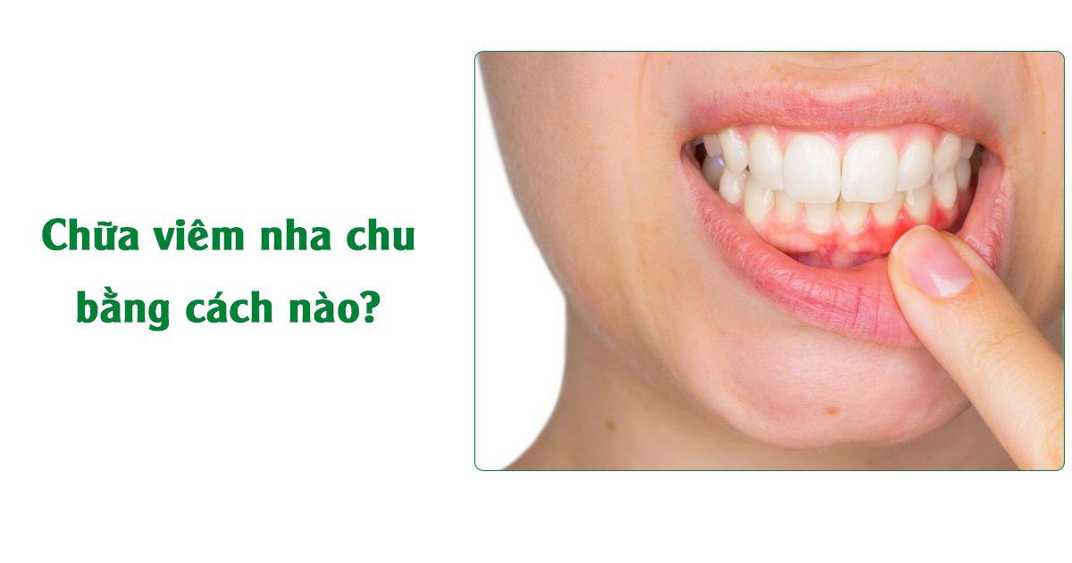 Chữa viêm nha chu bằng cách nào?