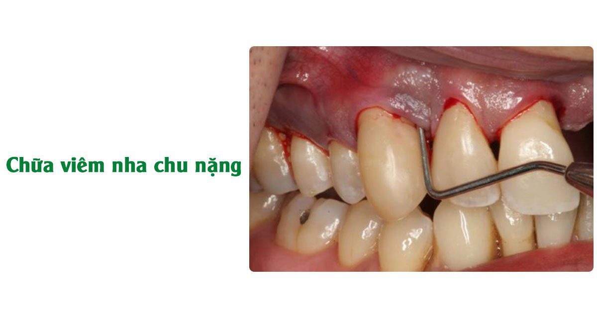 Chữa viêm nha chu nặng