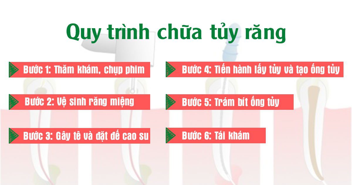 Quy trình chữa tủy răng