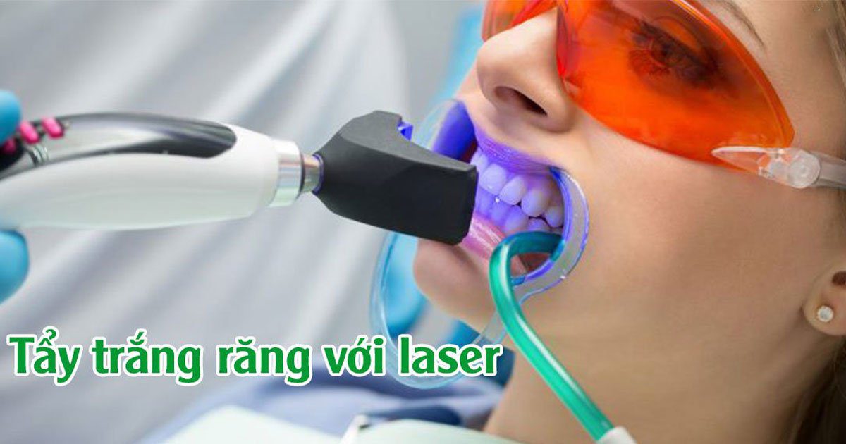 Tẩy trắng răng với laser