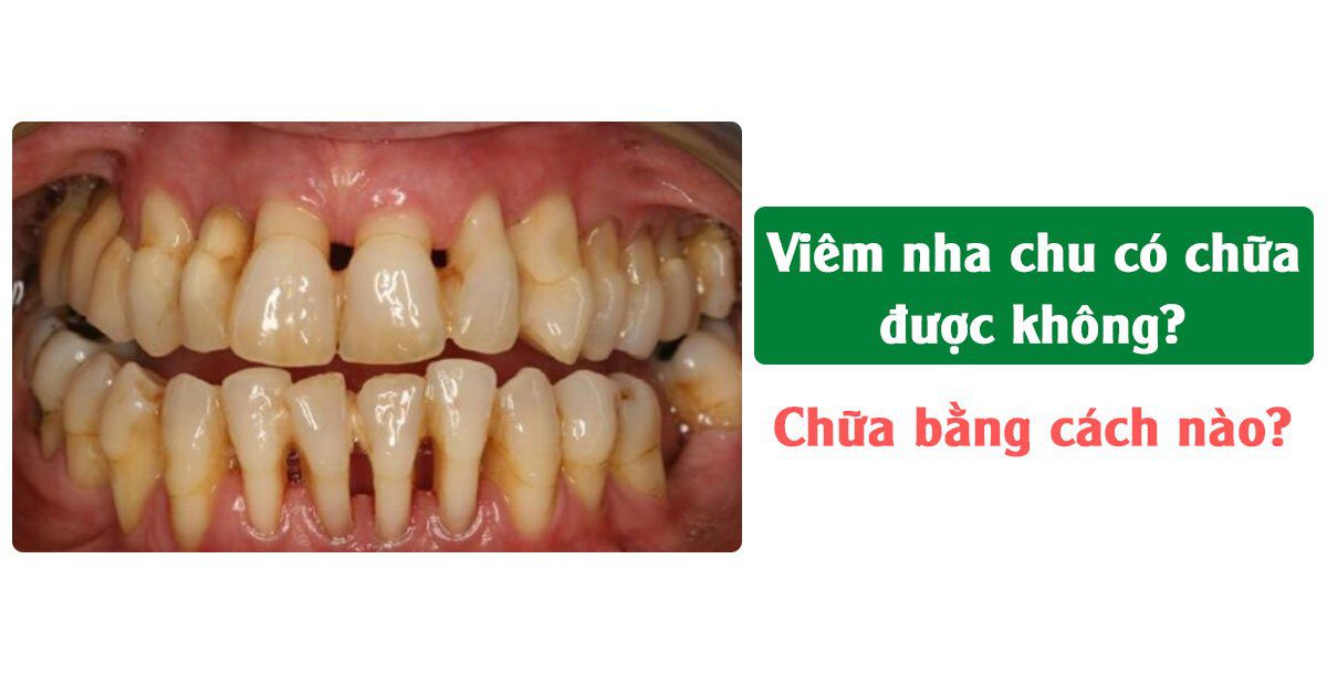 Viêm nha chu có chữa được không? Chữa bằng cách nào?