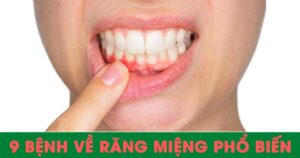 9 bệnh về răng miệng phổ biến
