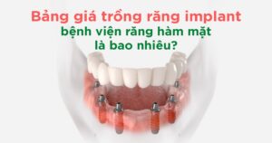 Bảng giá trồng răng implant bệnh viện răng hàm mặt là bao nhiêu?