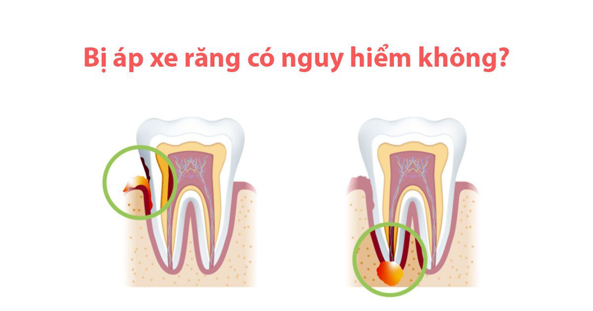 Bị áp xe răng có nguy hiểm không?