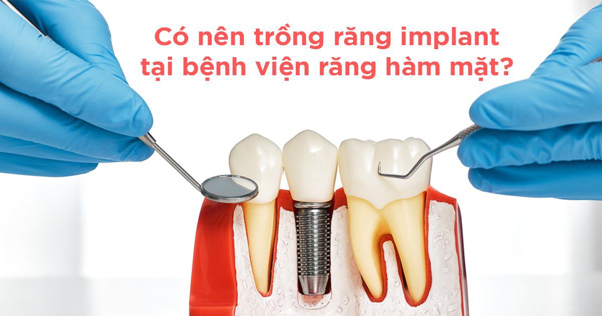 Có nên trồng răng implant tại bệnh viện răng hàm mặt?