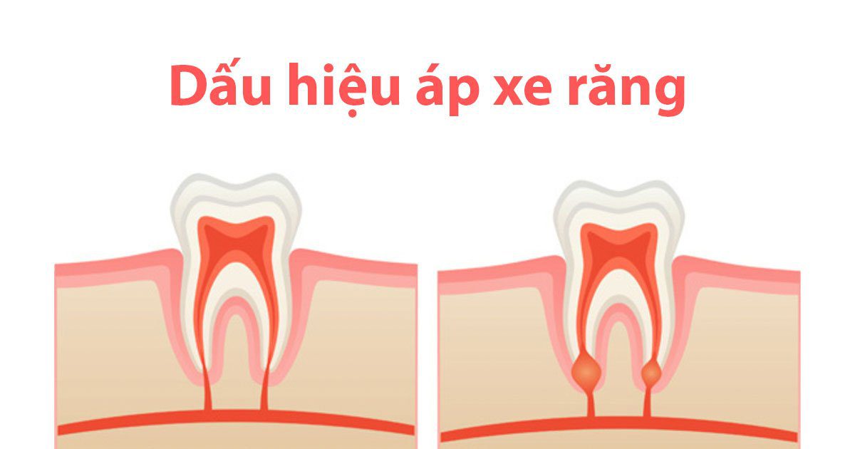 Dấu hiệu áp xe răng