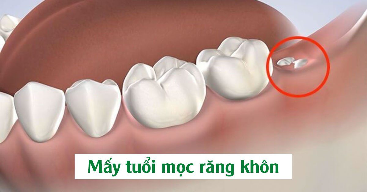 Mấy tuổi mọc răng 8