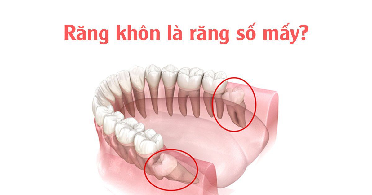 Răng khôn là răng số mấy?