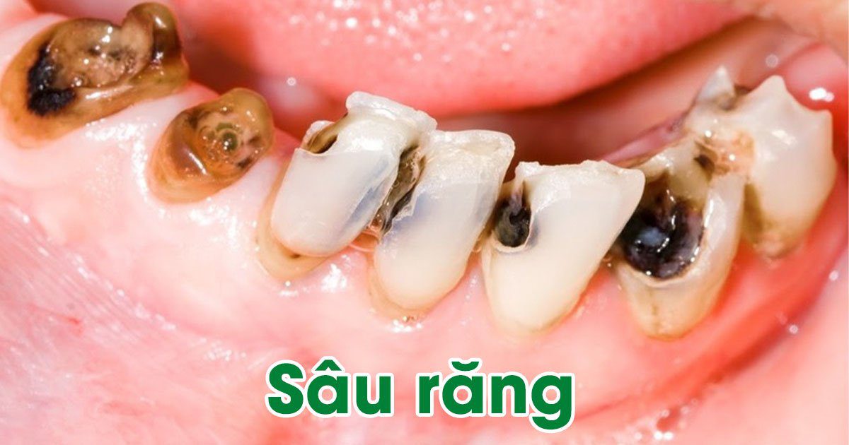 Sâu răng - bệnh về răng miệng phổ biến