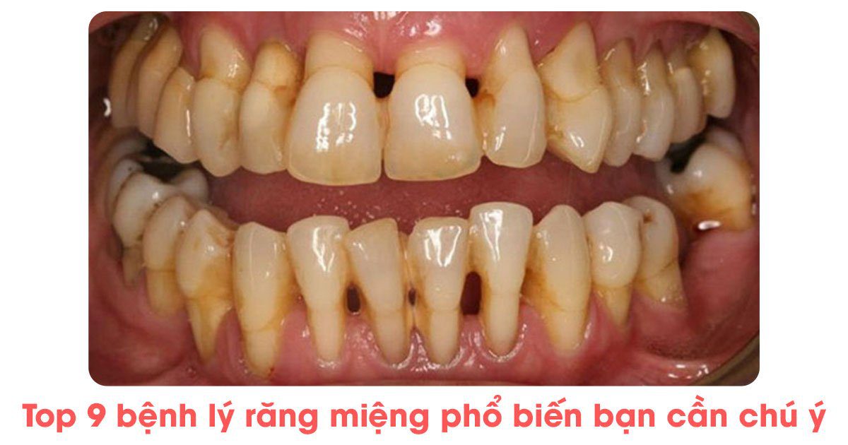 Top 9 bệnh về răng miệng phổ biến bạn cần chú ý