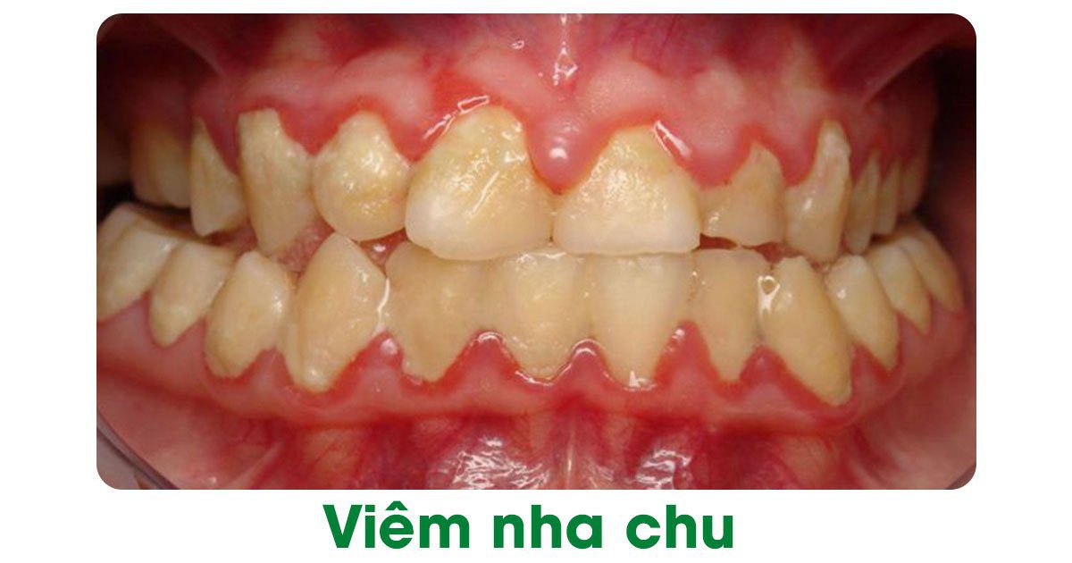 Viêm nha chu