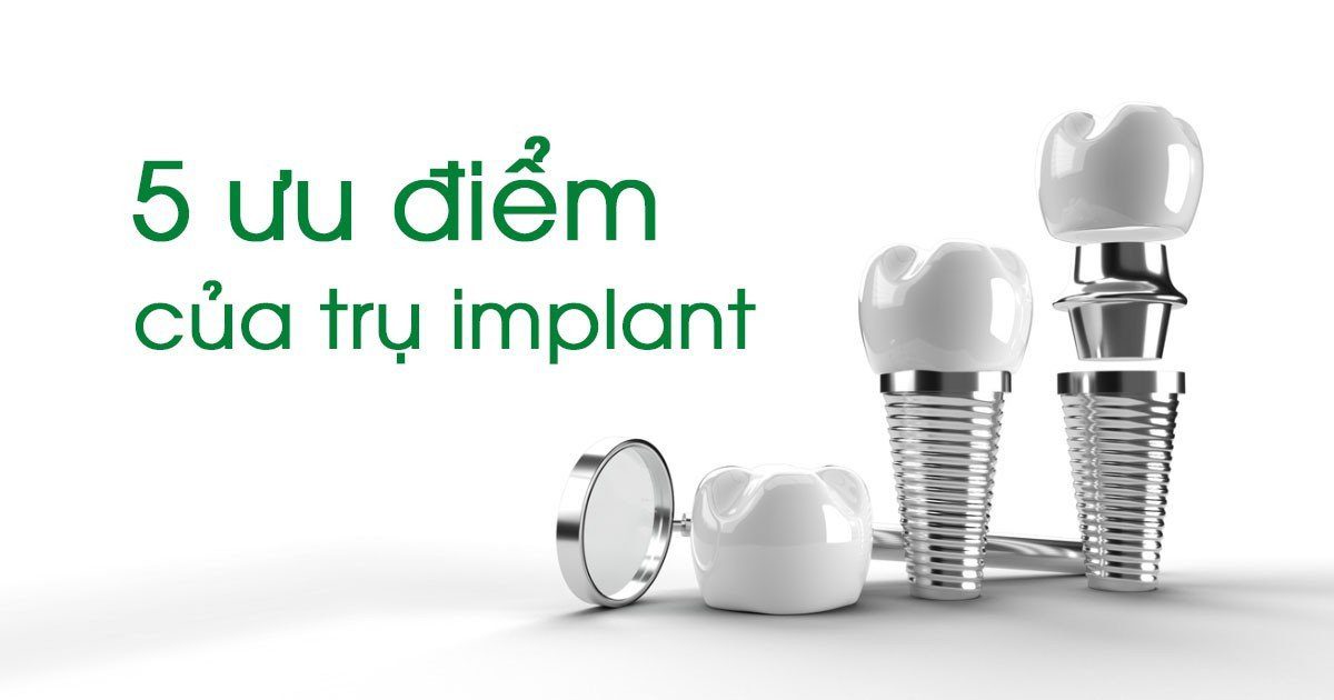 5 ưu điểm của trụ implant