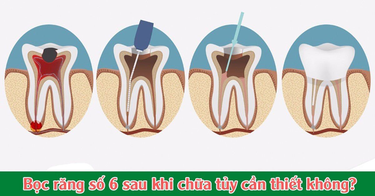 Bọc răng số 6 sau khi chữa tủy cần thiết không?