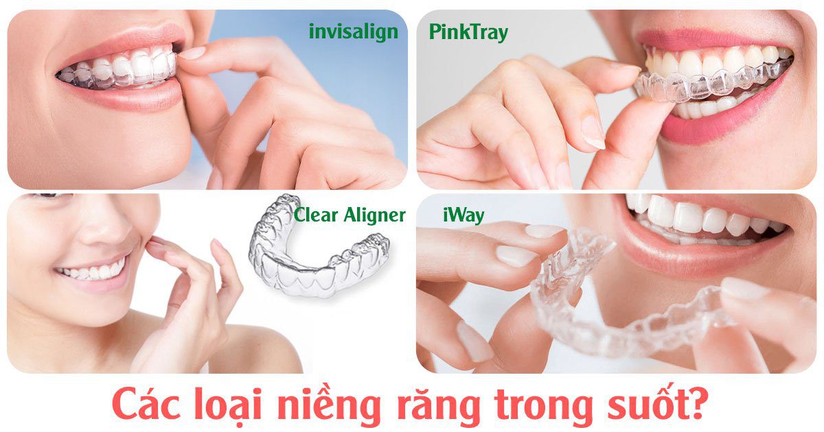 Các loại niềng răng trong suốt