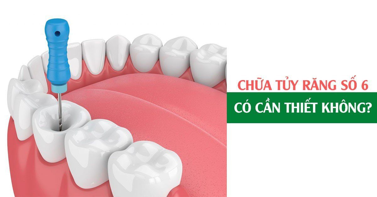 Chữa tủy răng số 6 có cần thiết không?