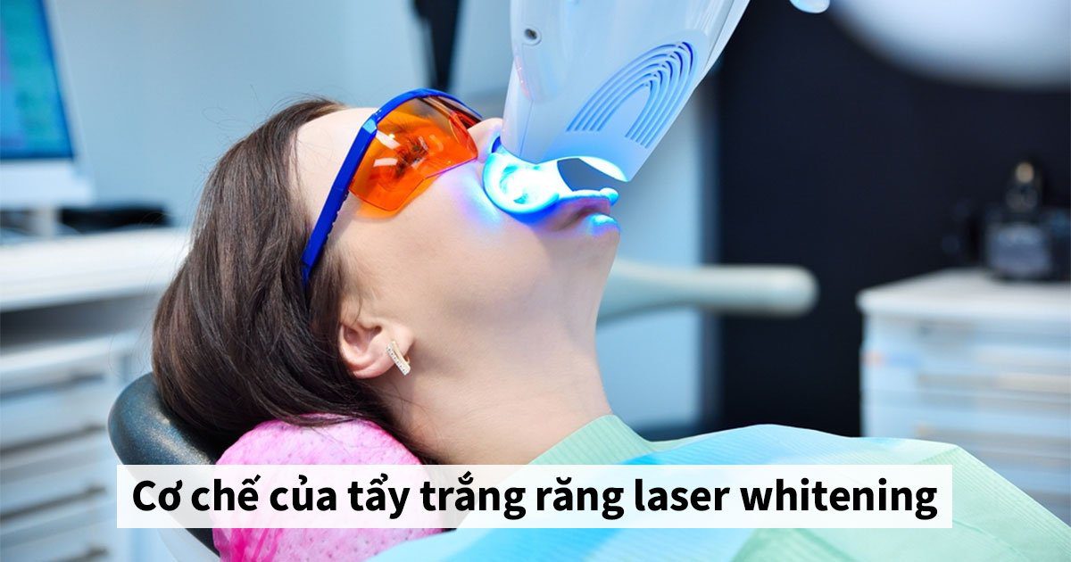 Cơ chế của tẩy trắng răng laser whitening