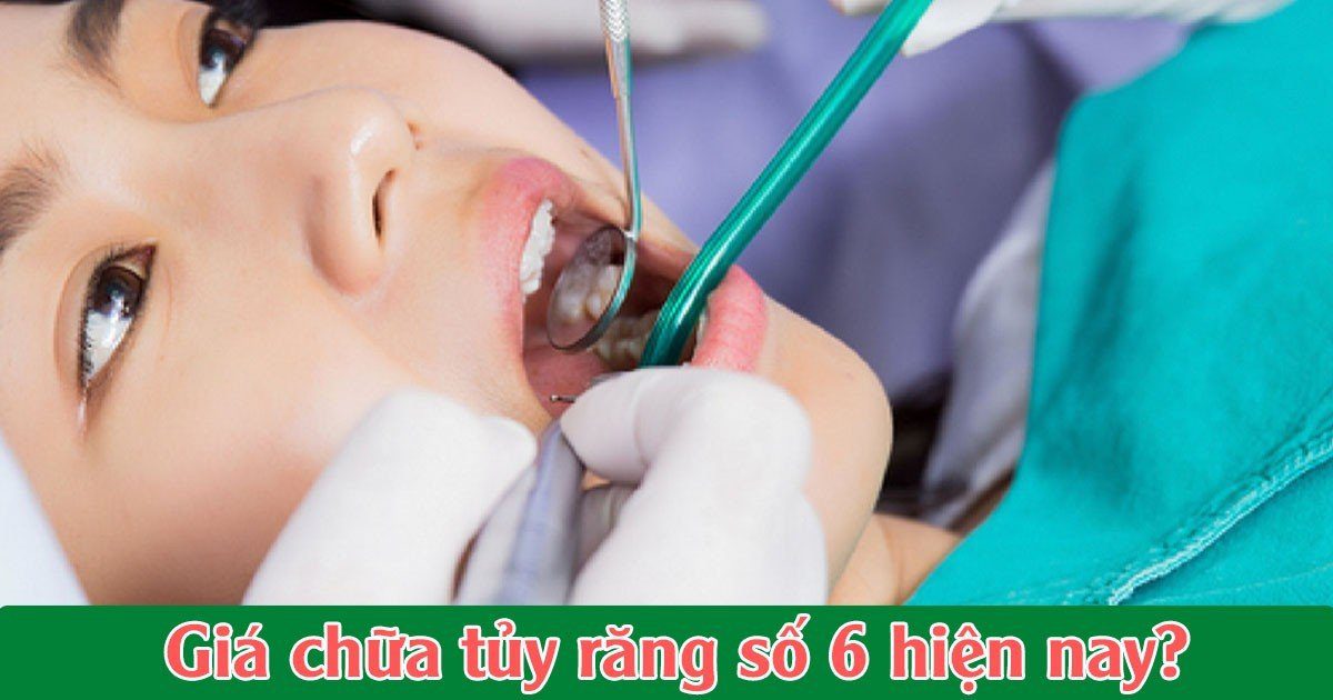 Giá chữa tủy răng số 6 hiện nay?