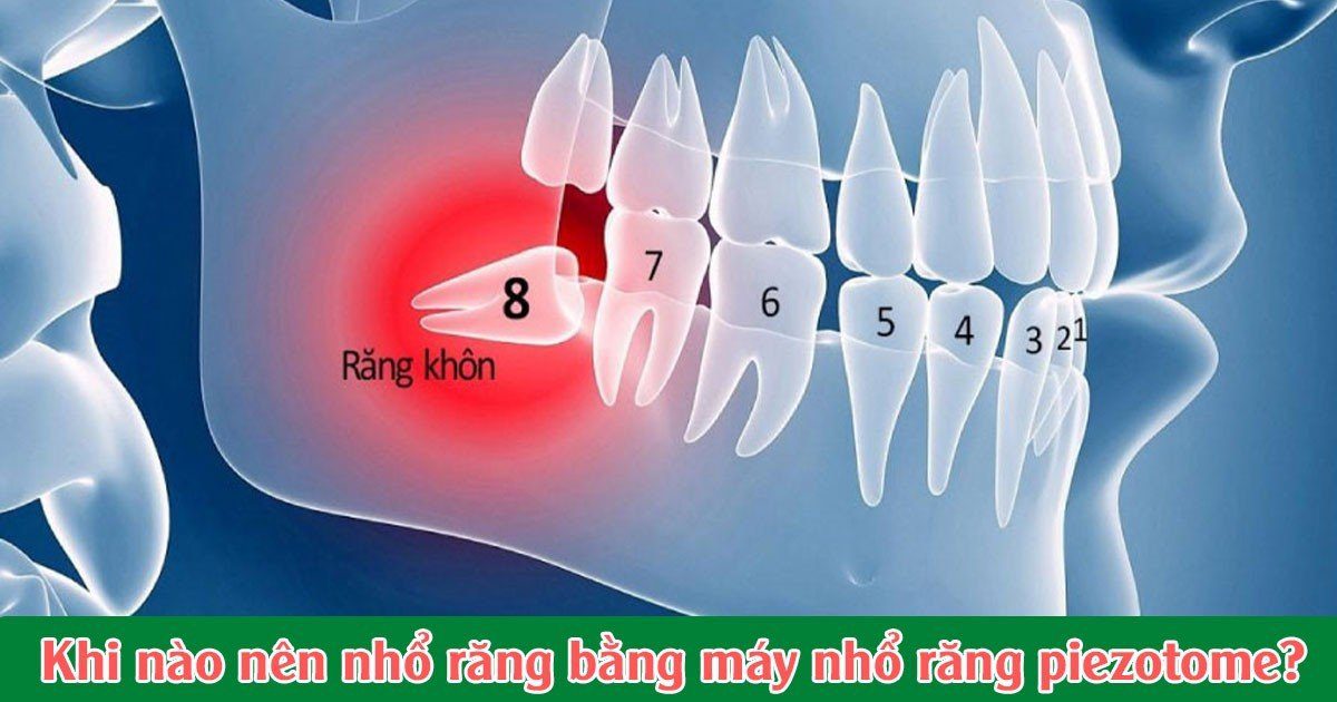 Khi nào nên nhổ răng bằng máy nhổ răng piezotome?