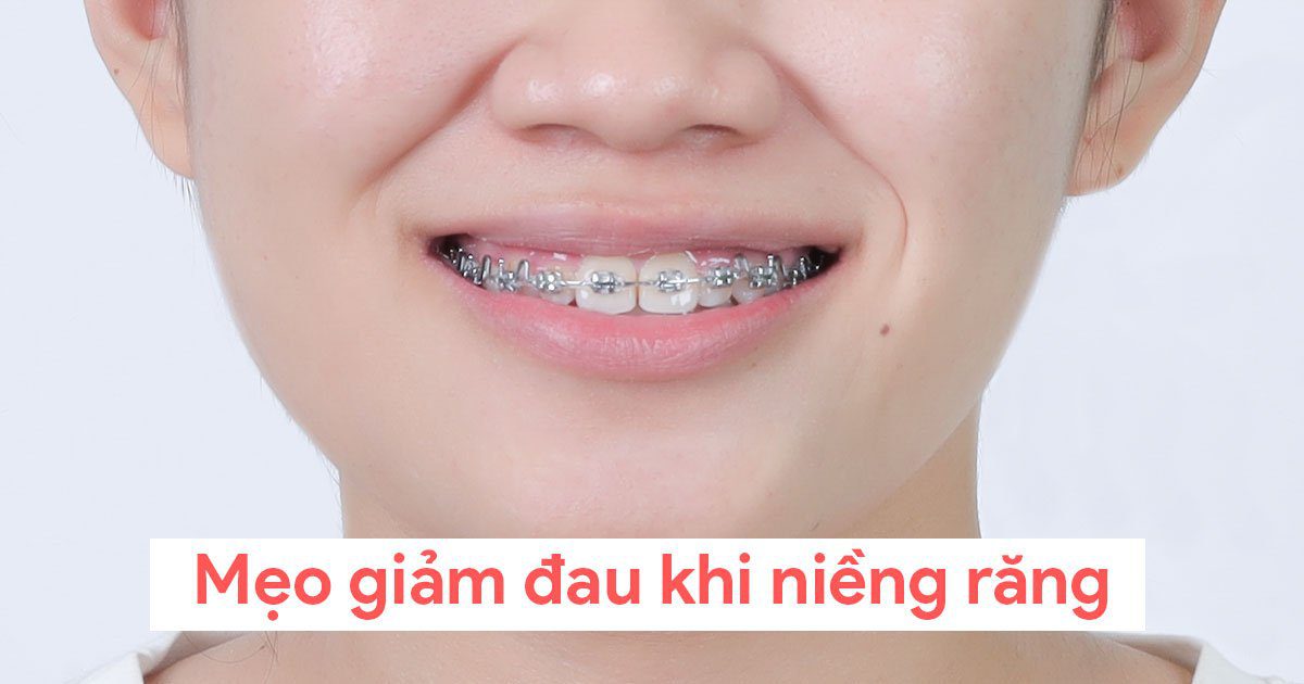 Mẹo giảm đau khi niềng răng