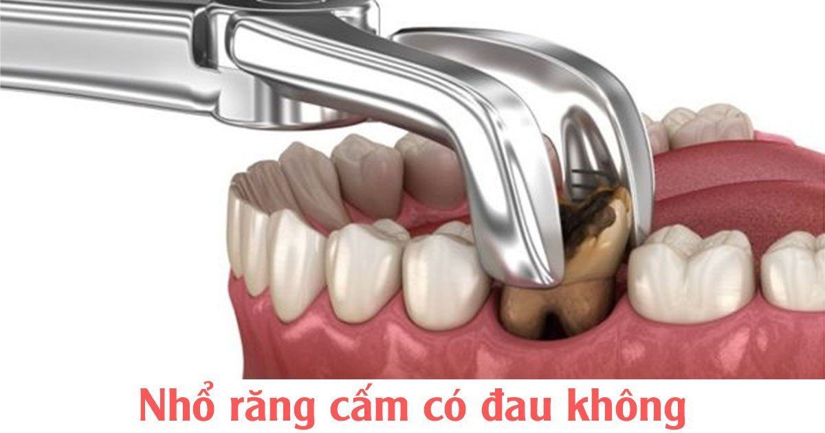 Nhổ răng cấm có đau không?