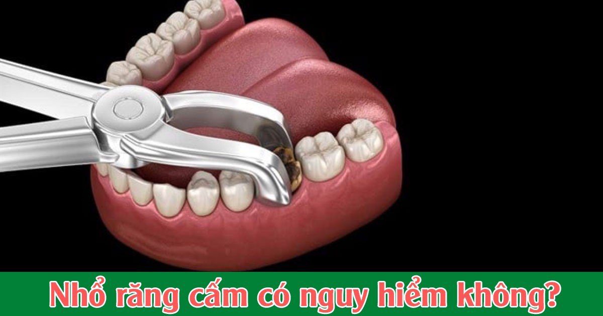 Nhổ răng cấm có nguy hiểm không?