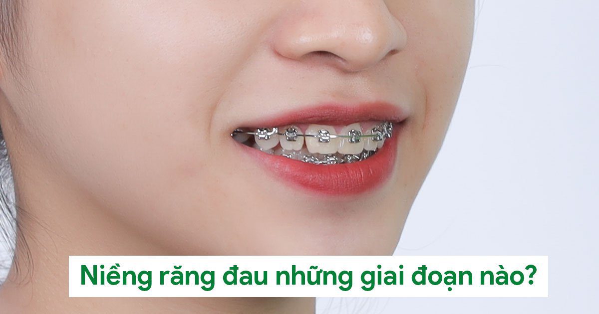 Gắn mắc cài