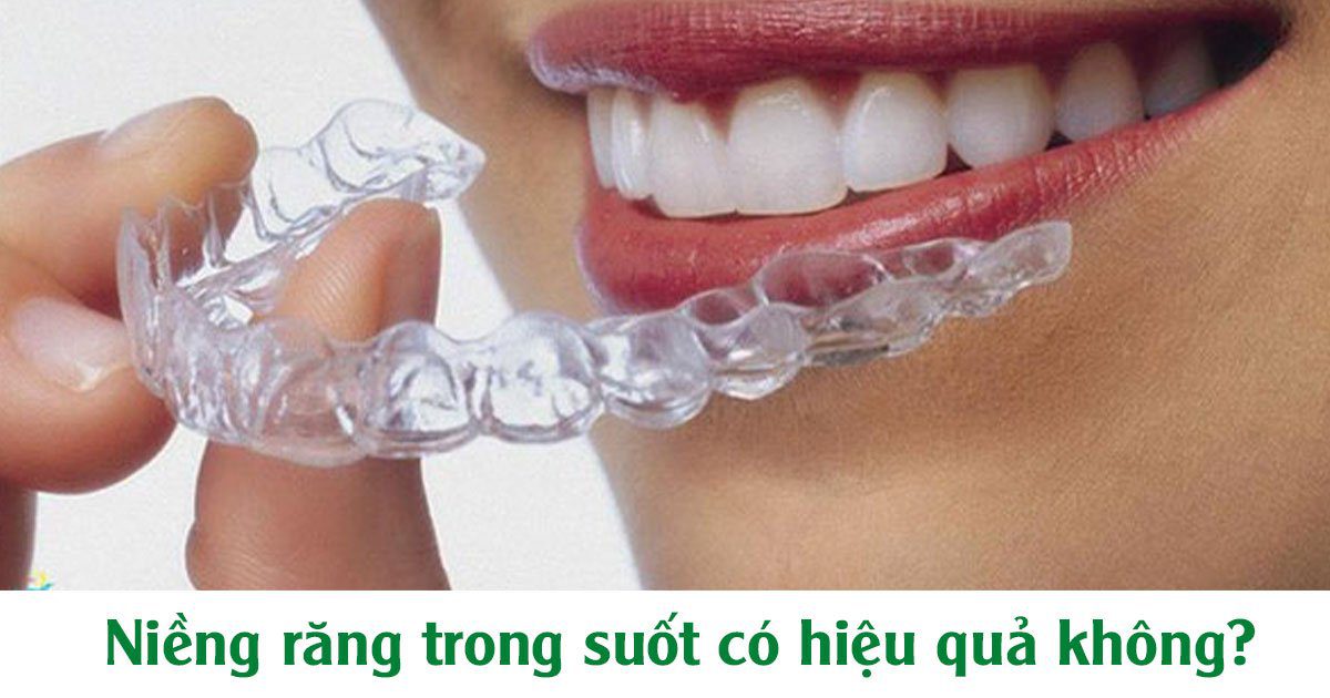 Niềng răng trong suốt có hiệu quả không?