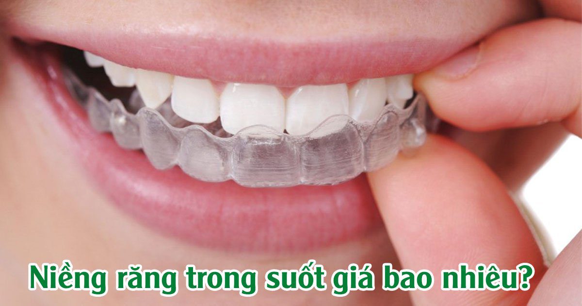 Niềng răng trong suốt giá bao nhiêu?